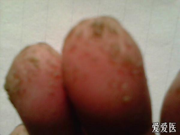 假性尖锐疣柚子粒图片图片