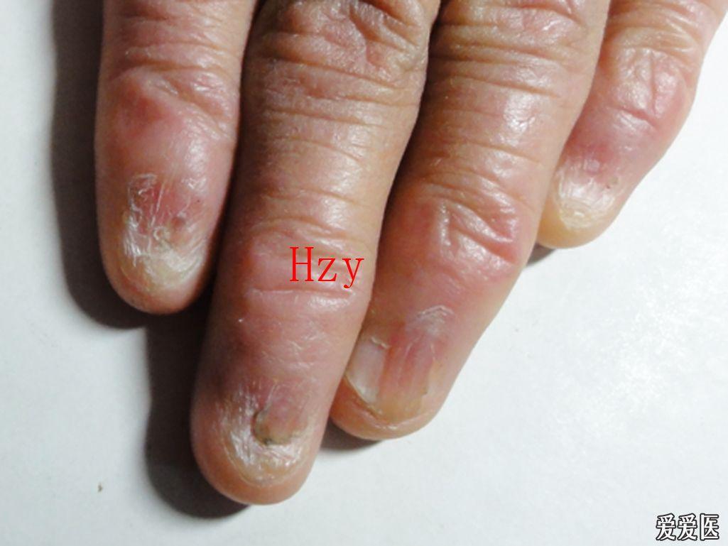 看图诊病--------甲扁平苔藓