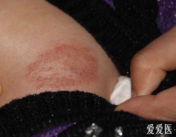 影像科医生求助 自己身上长的东西 大家看看是什么?