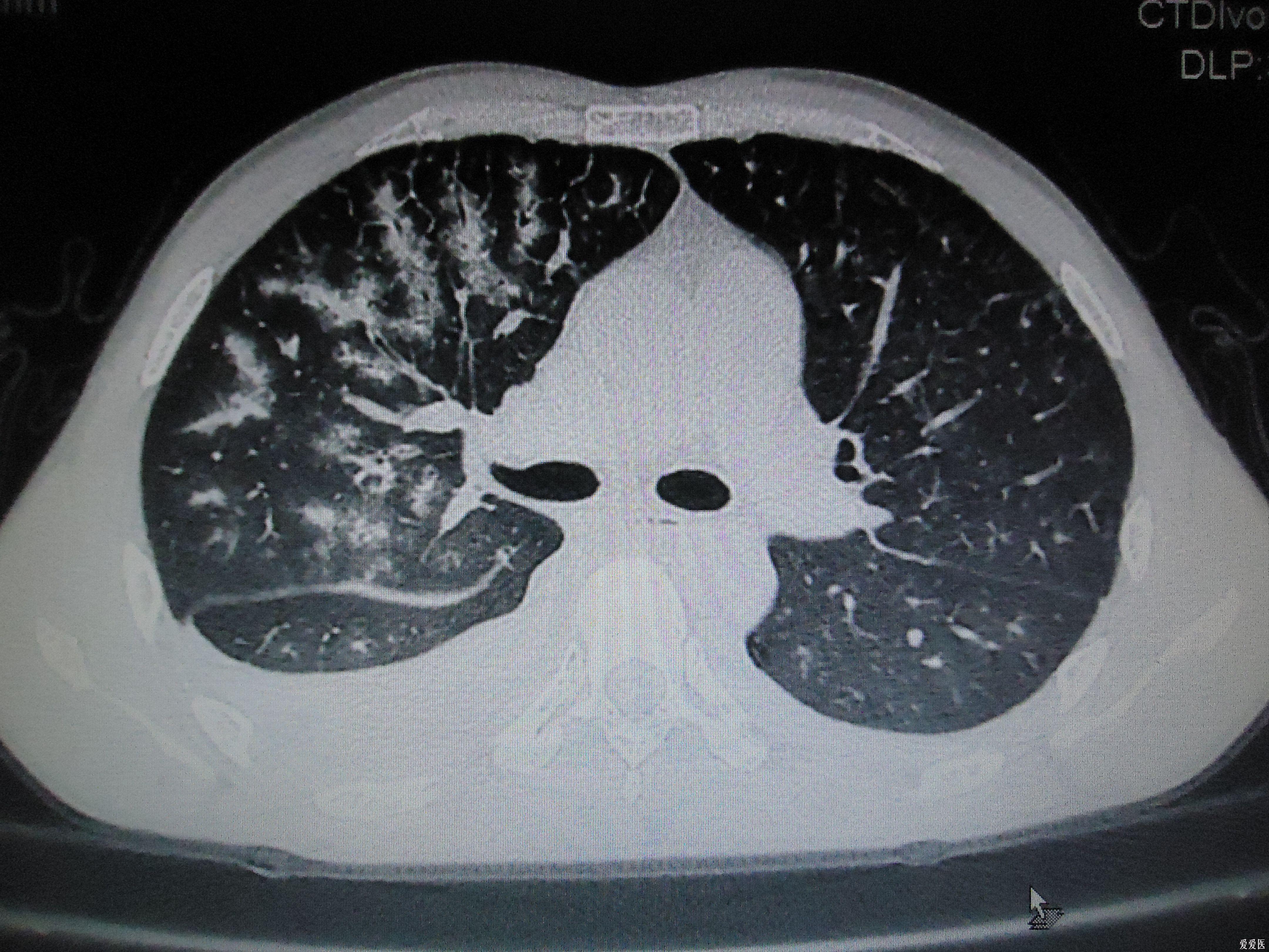 肺部x线 ct片