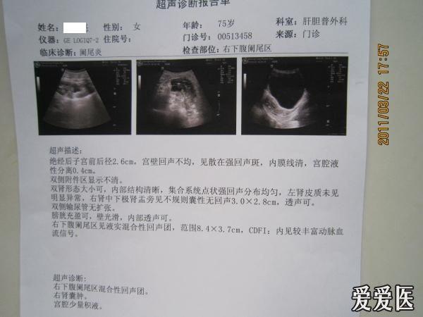 阑尾炎的超声报告模板图片