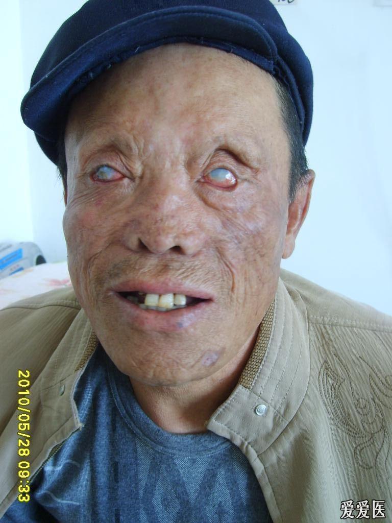 楼主争做良医2011-03-30 20:16:342010年参加麻风病学习班,并去了麻风