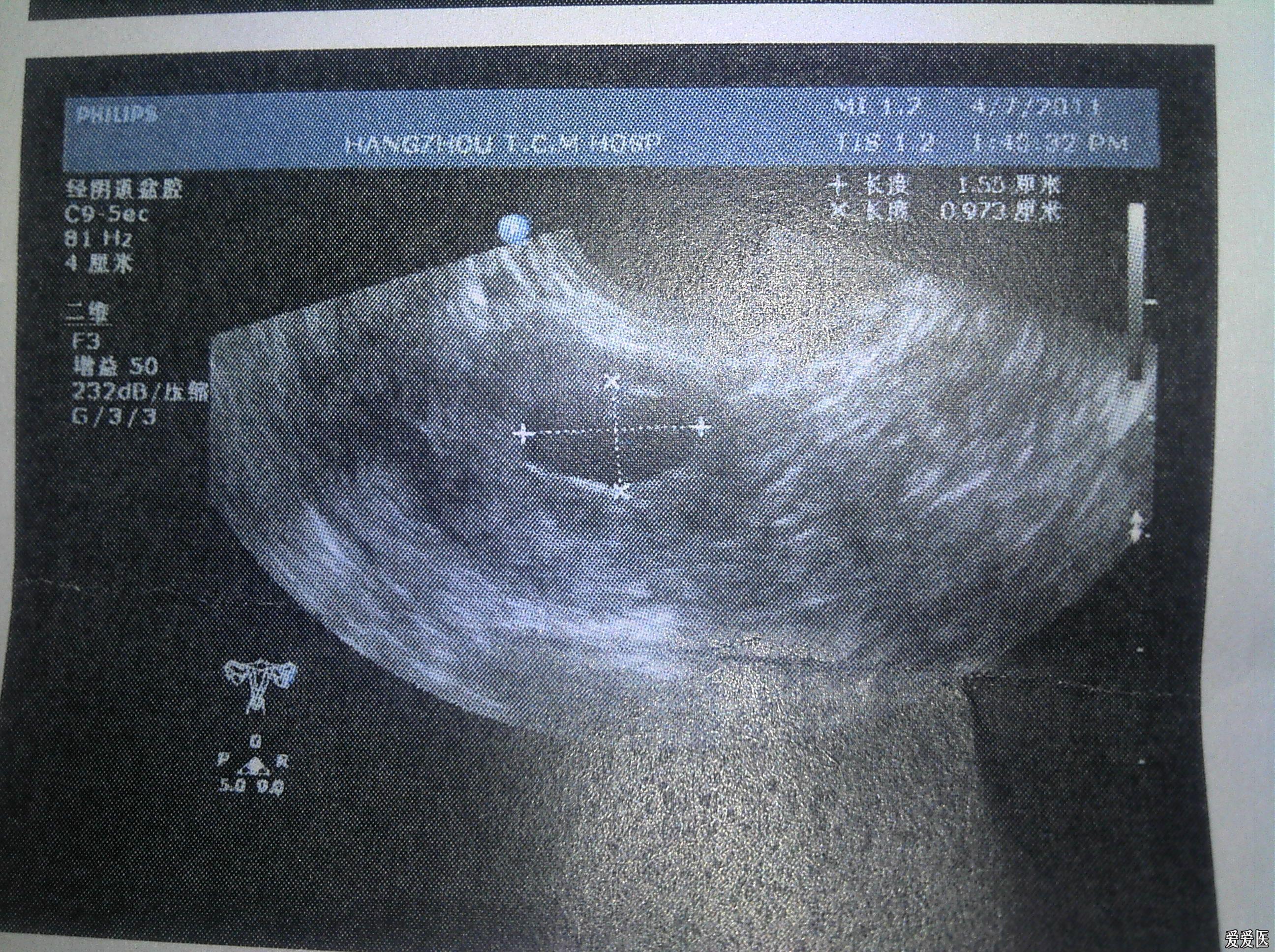 这个b超单 是宫腔粘连吗?