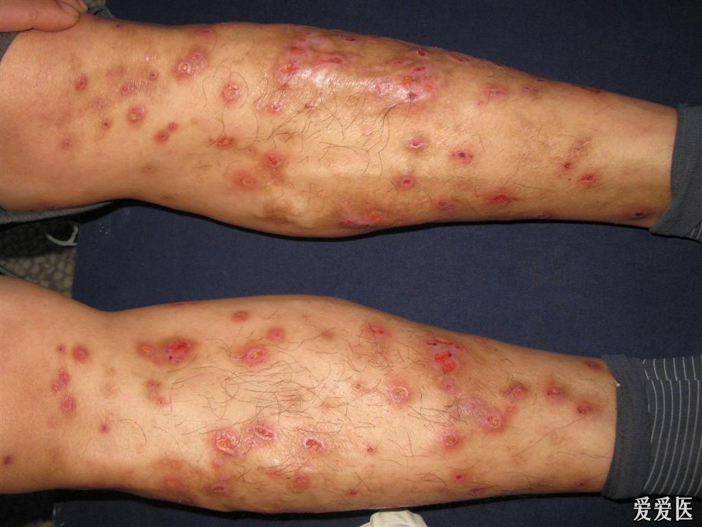 病毒感染的痒疹是图片图片