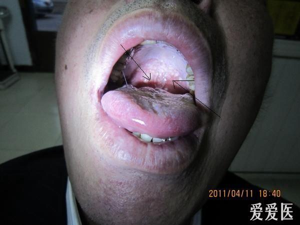 舌苔黄,咽颊及上腭部可见较多的点状白色分泌物,局部融合成小片(如图)