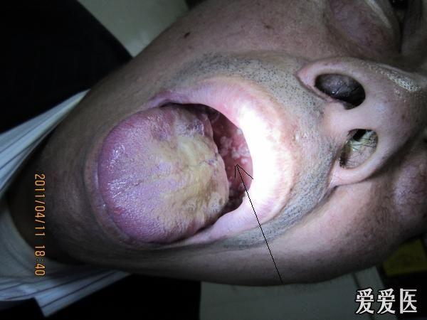 口腔黏膜柯氏斑图片