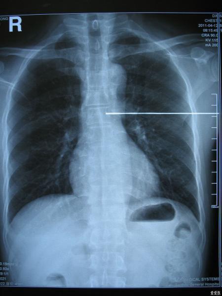 胸部x射线 ct增强片 帮帮忙看一下 是肺癌吗?