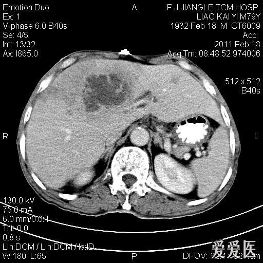 肝脓肿影像图片