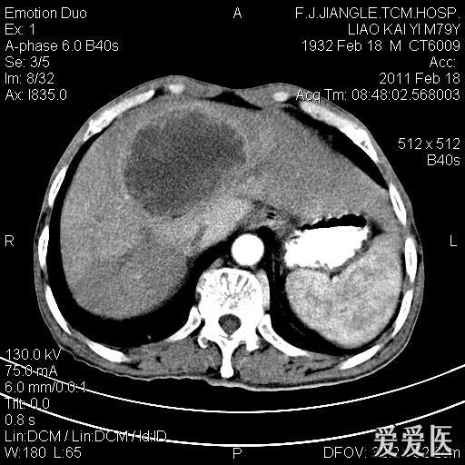 一例确诊的肝脓肿,ct平扫 增强