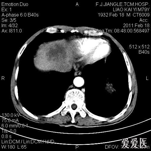 一例确诊的肝脓肿,ct平扫 增强