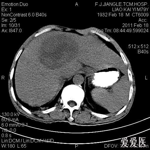 一例确诊的肝脓肿,ct平扫 增强