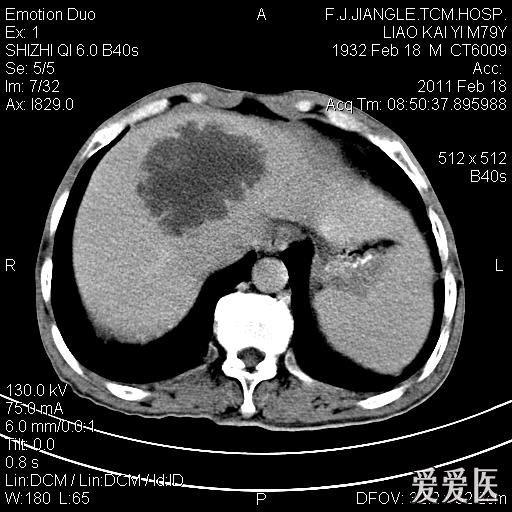 一例确诊的肝脓肿,ct平扫 增强
