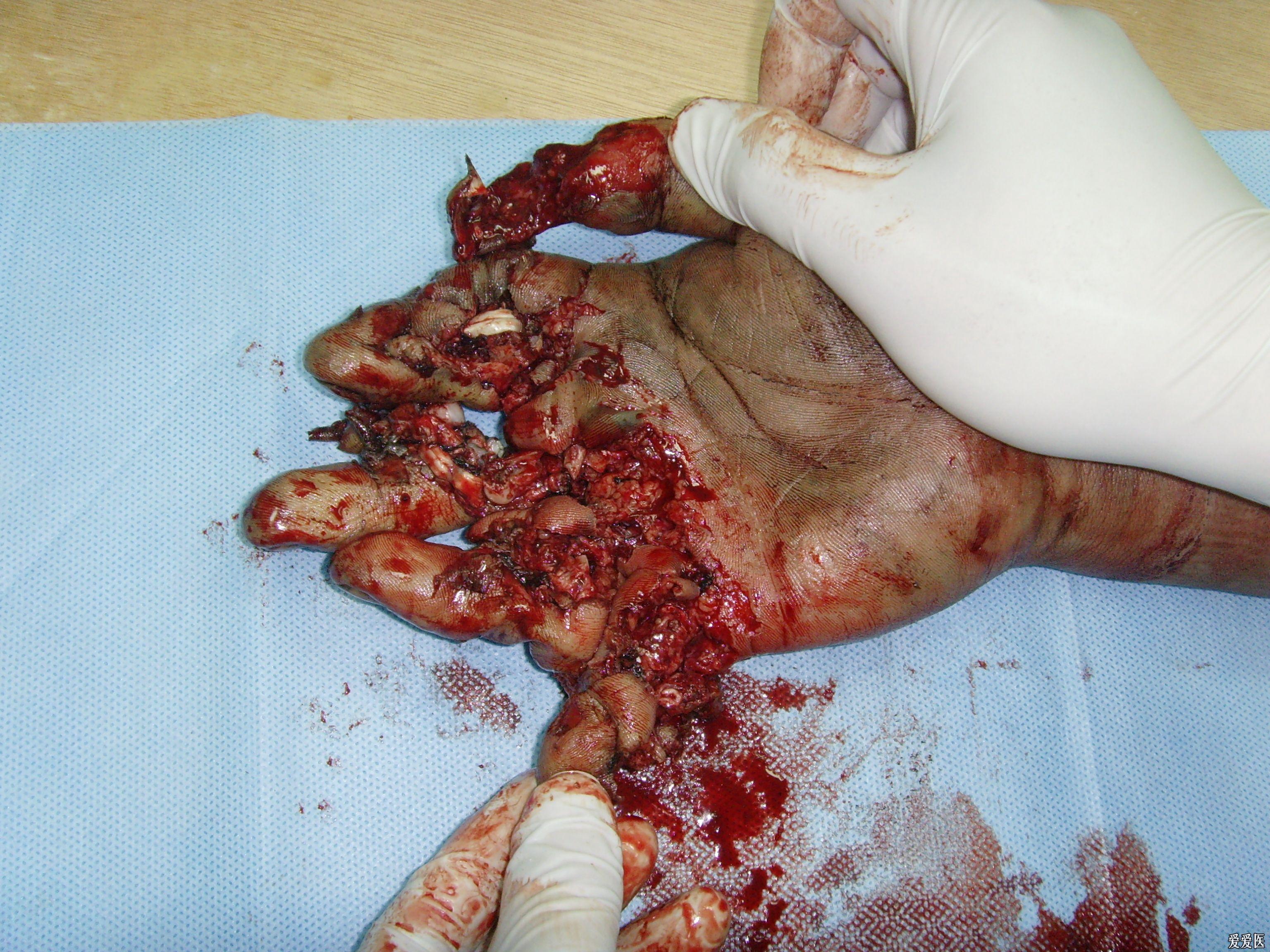把这个病人的手做成这样,会不会对不起病人?