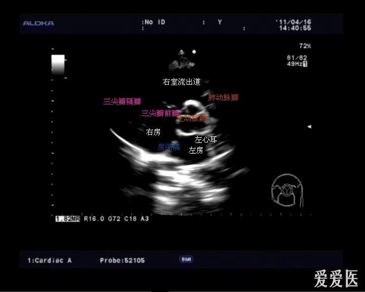 右室流出道切面图片