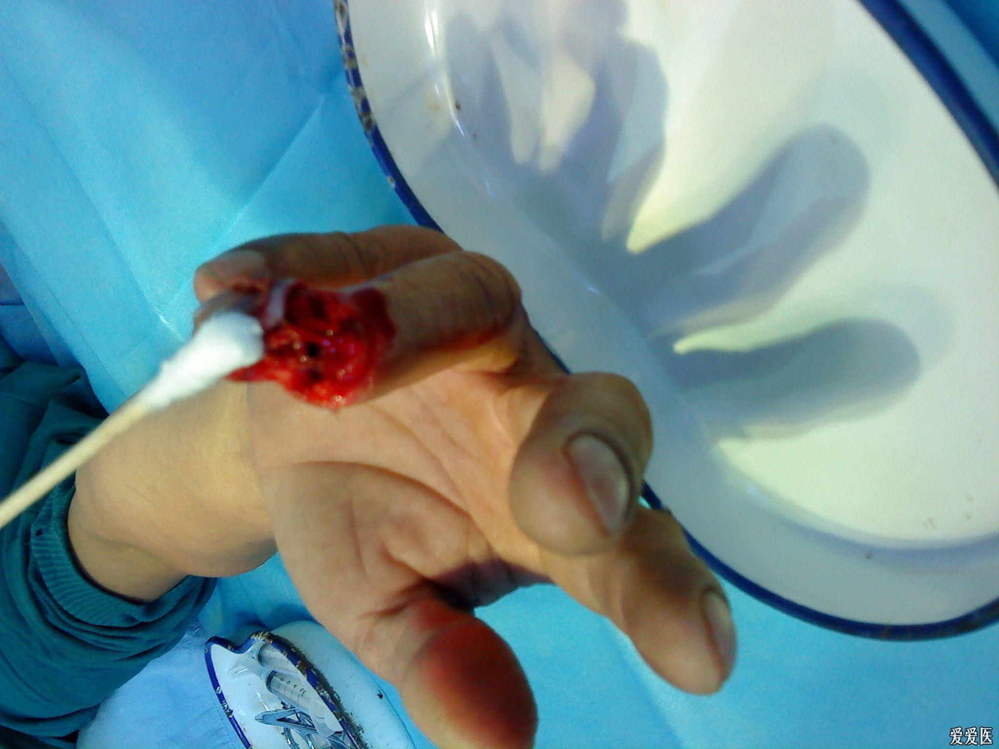 右手环指末节开放性骨折