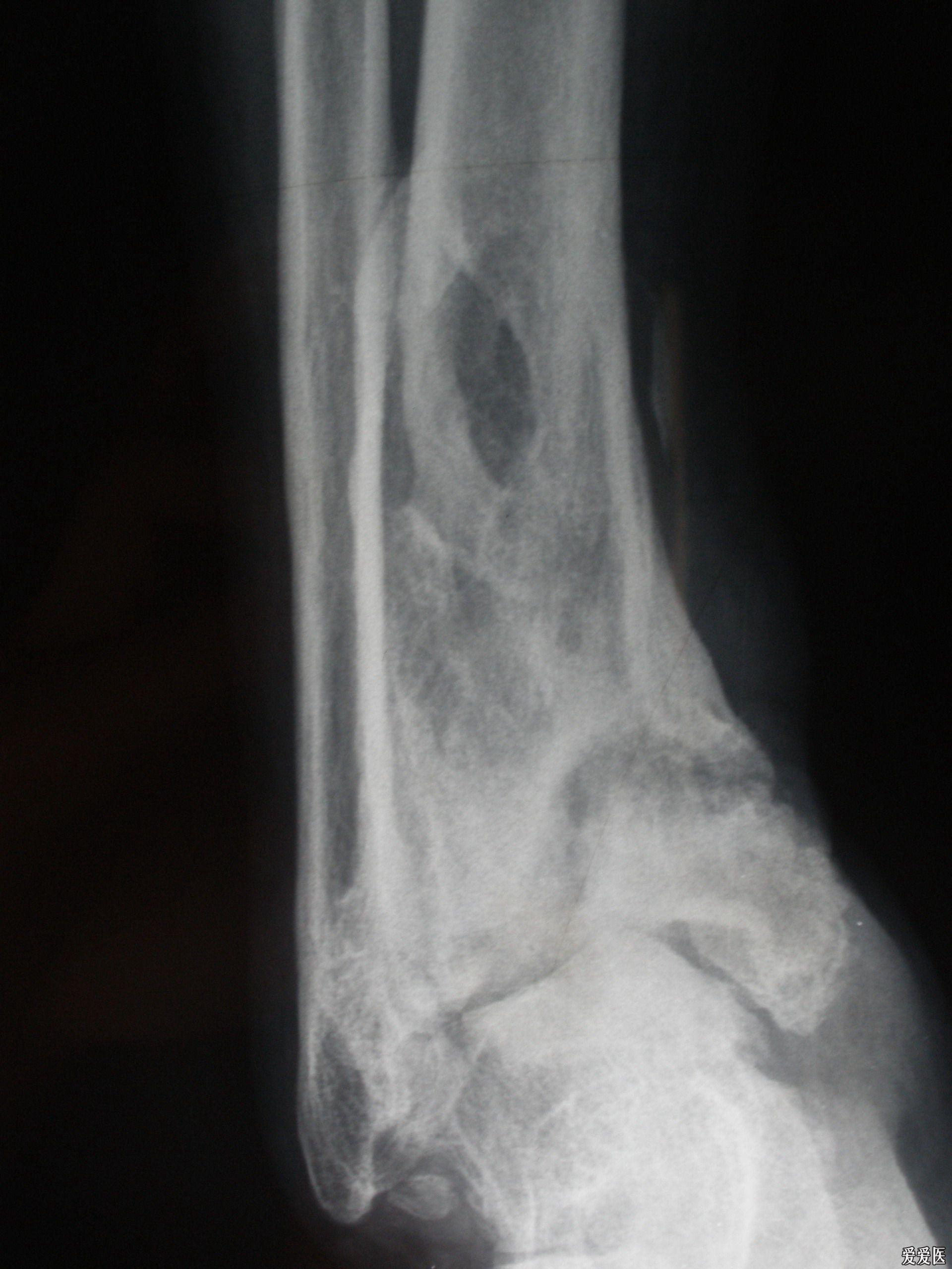 创伤性踝关节炎一例