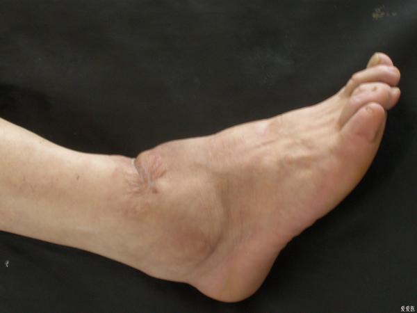 脚踝滑膜炎症状图片图片