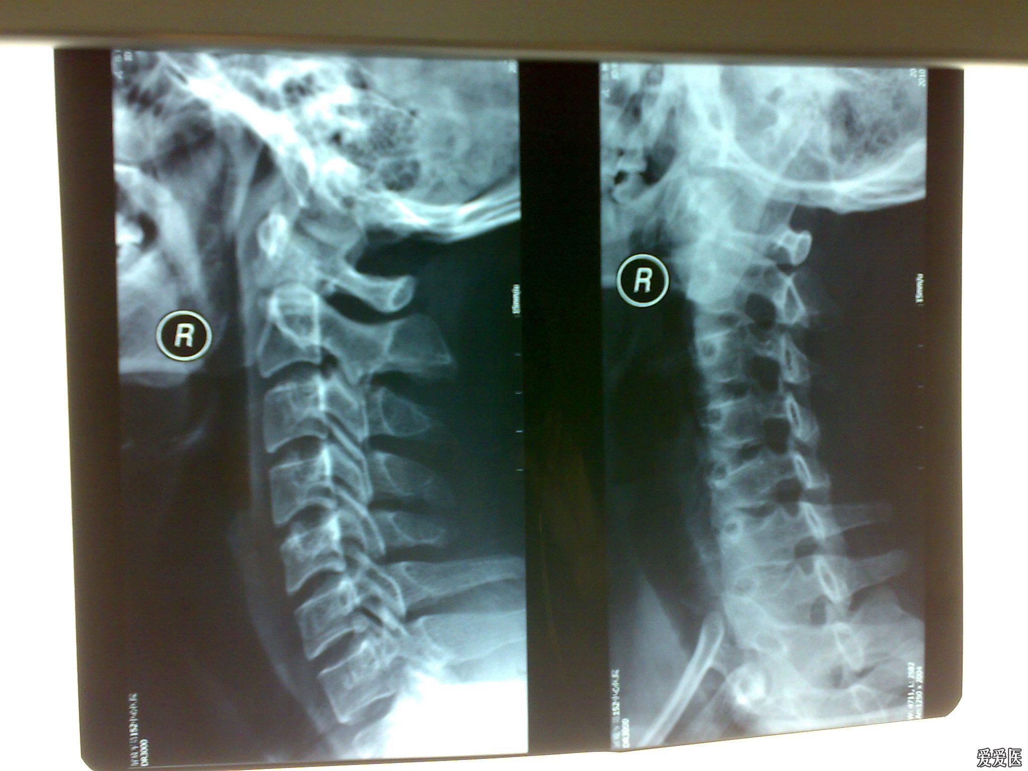 颈椎侧位片正常的图片图片