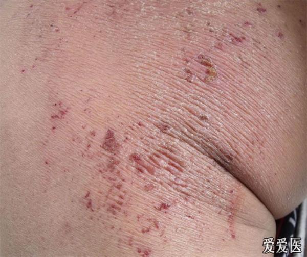 看看屁股上是什么病