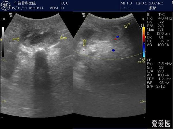 左臀部包块,坐骨结节囊肿伴内出血?