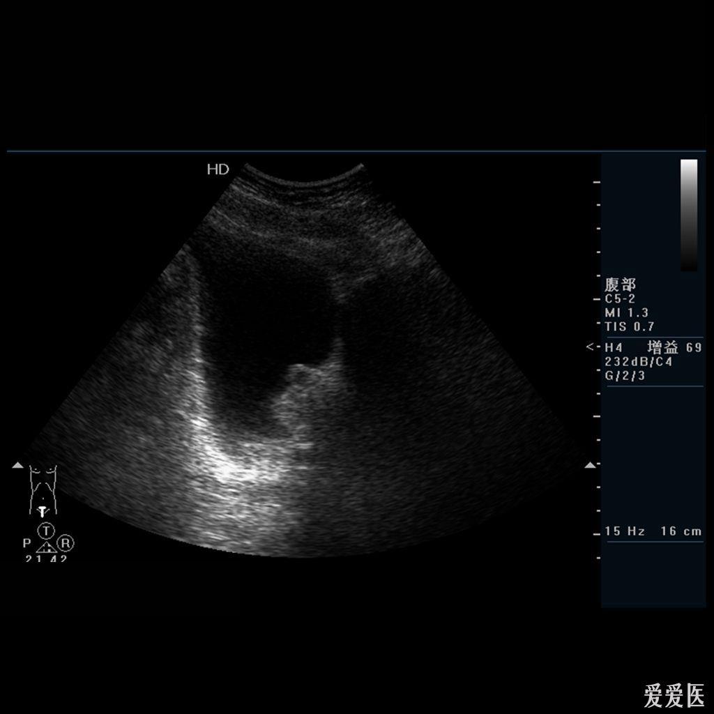前列腺囊肿彩超图片图片