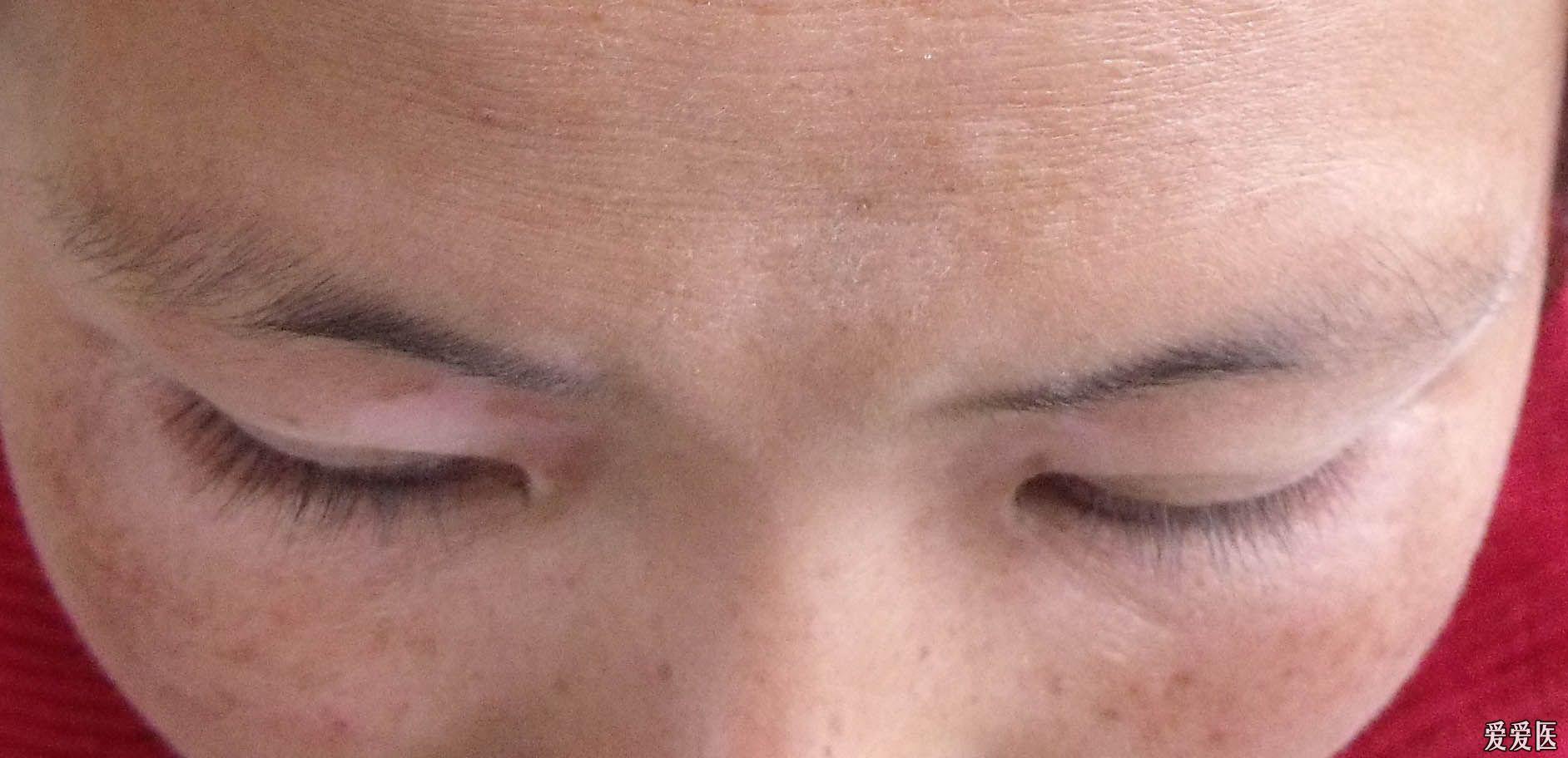 白癜风 用药一周后变化