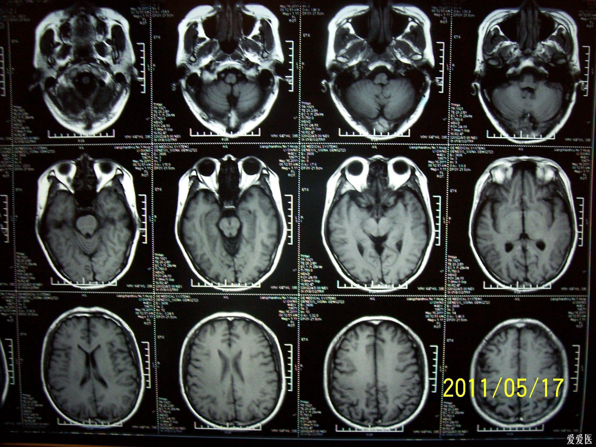 我是医师,但对脑科可是菜鸟,请高手解惑.