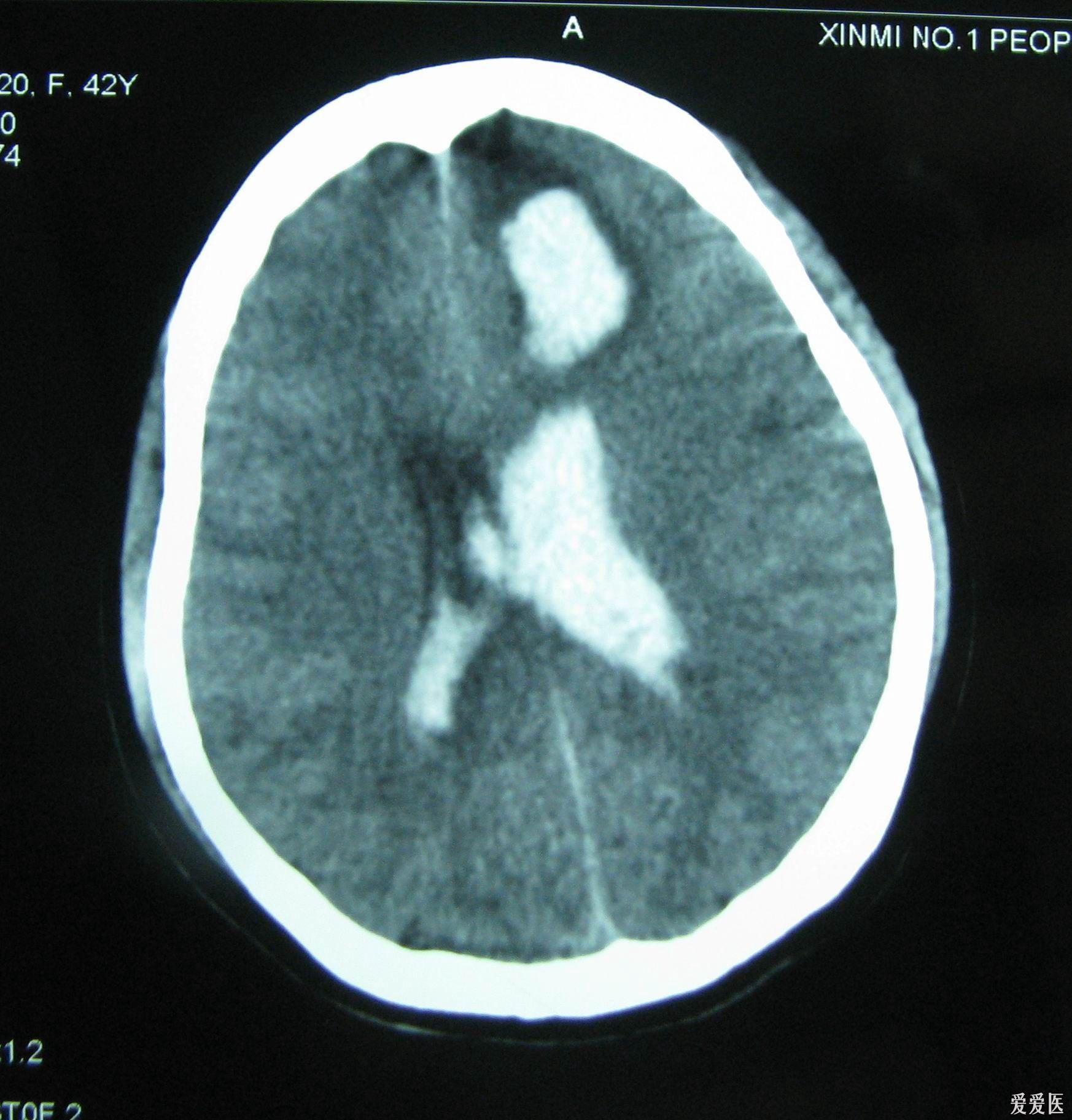 脑出血破入脑室,如何处理?