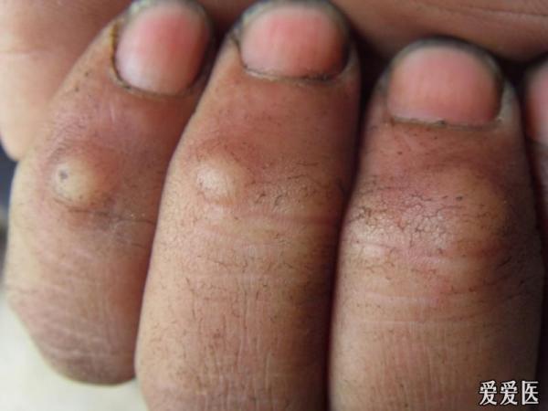 手指末节关节病变