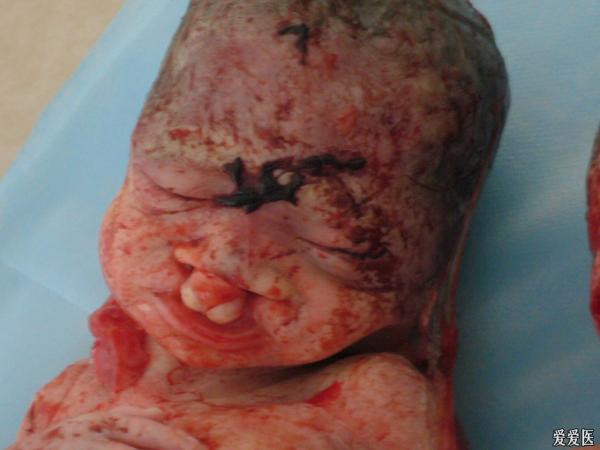 双胎唇裂合并腭裂