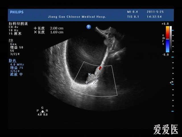 膀胱壁上的东东 望各位老师多给指点质点