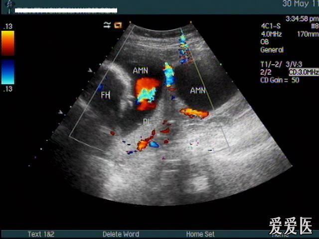 轮状胎盘图片超声图片