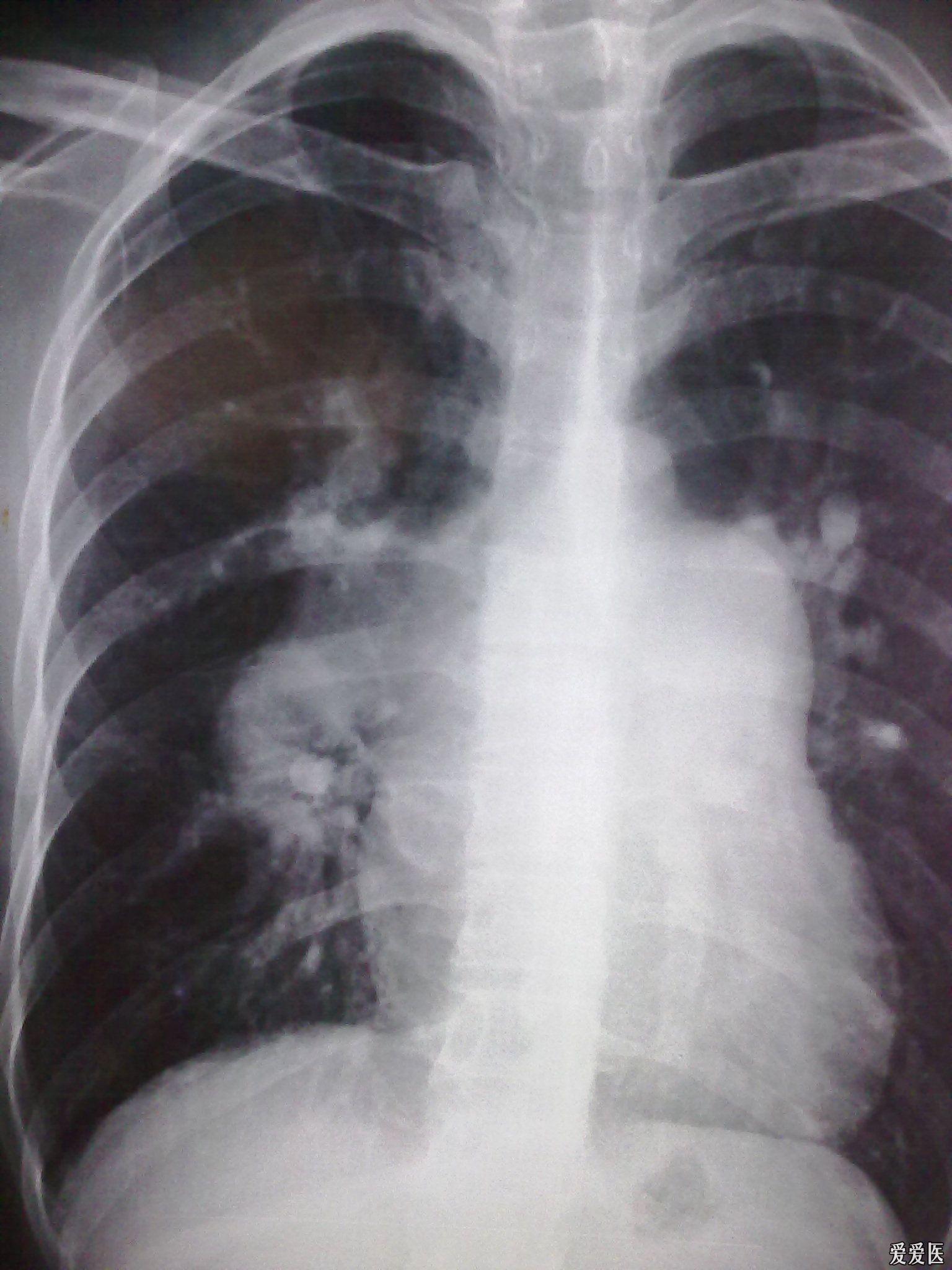 典型肺动脉高压胸片(室间隔缺损)