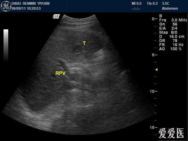 肝血管瘤图片彩超图片