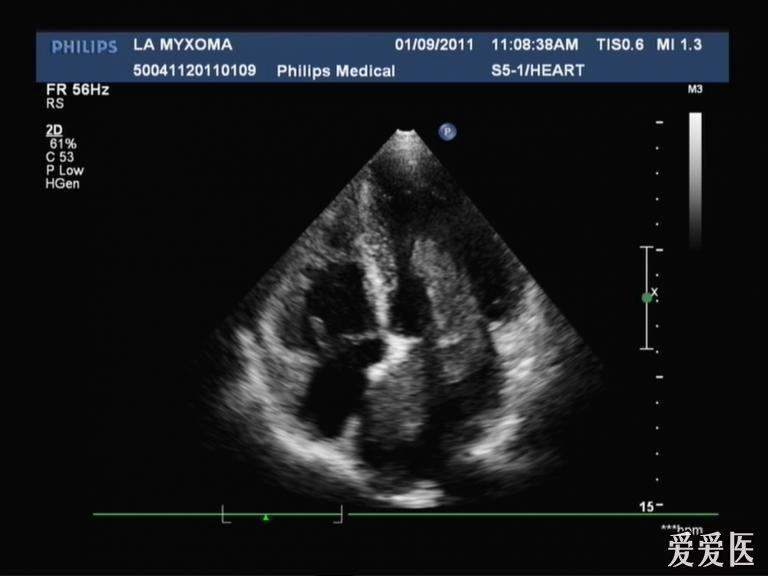 心脏粘液瘤超声图片图片