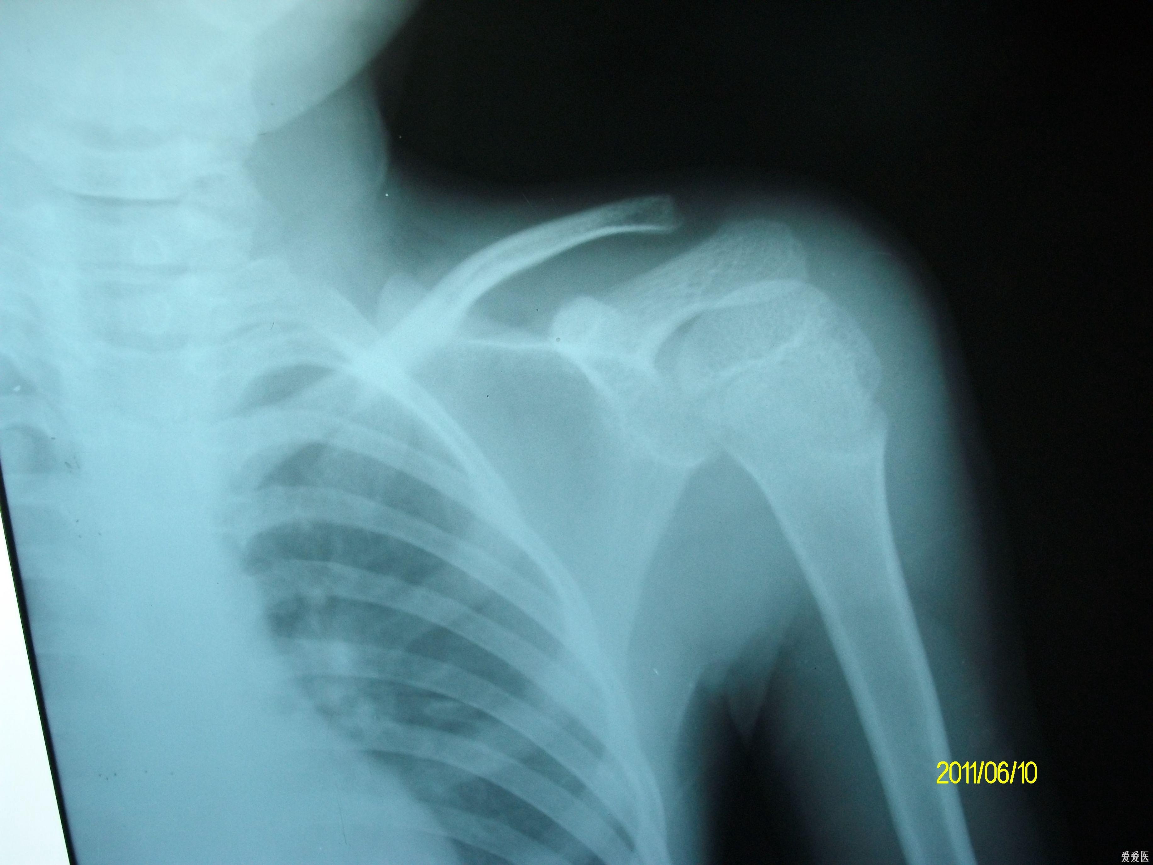 正常肱骨x线图片图片