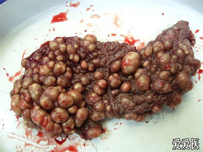 阴囊皮脂腺瘤图片