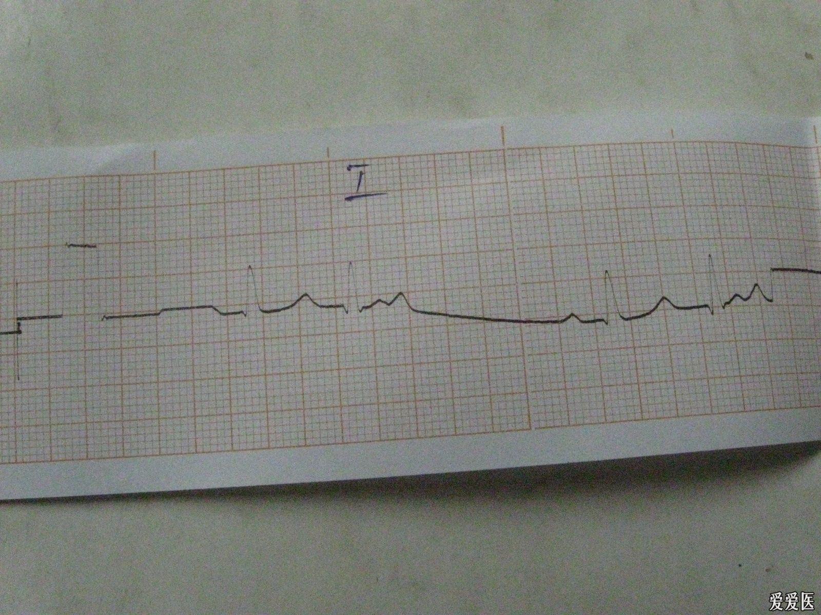 右位心一例求助