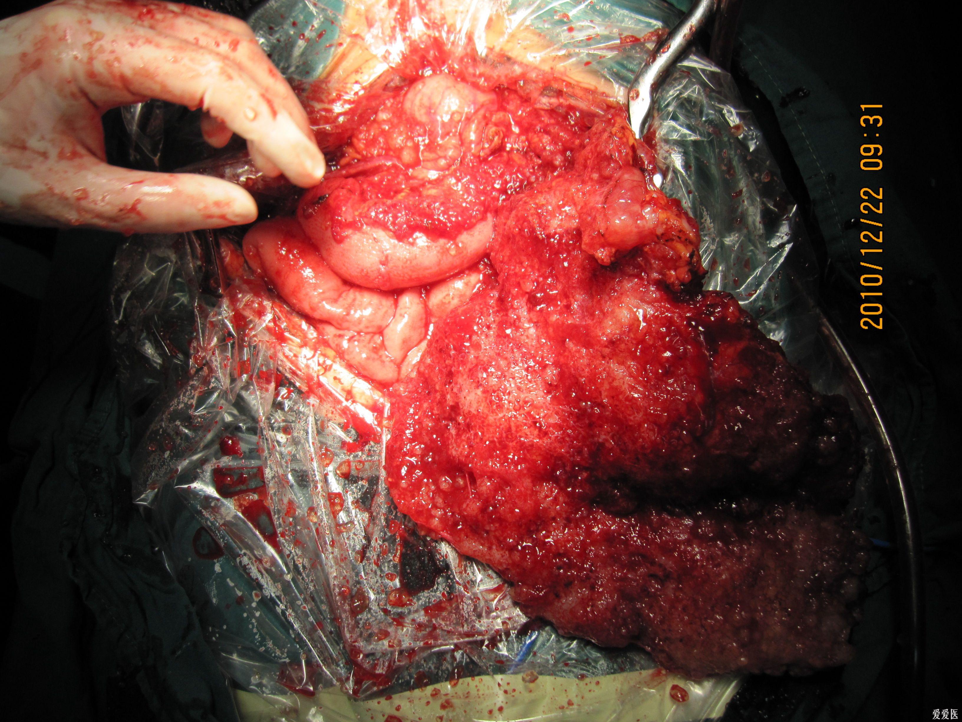 腹膜 粘液瘤图片