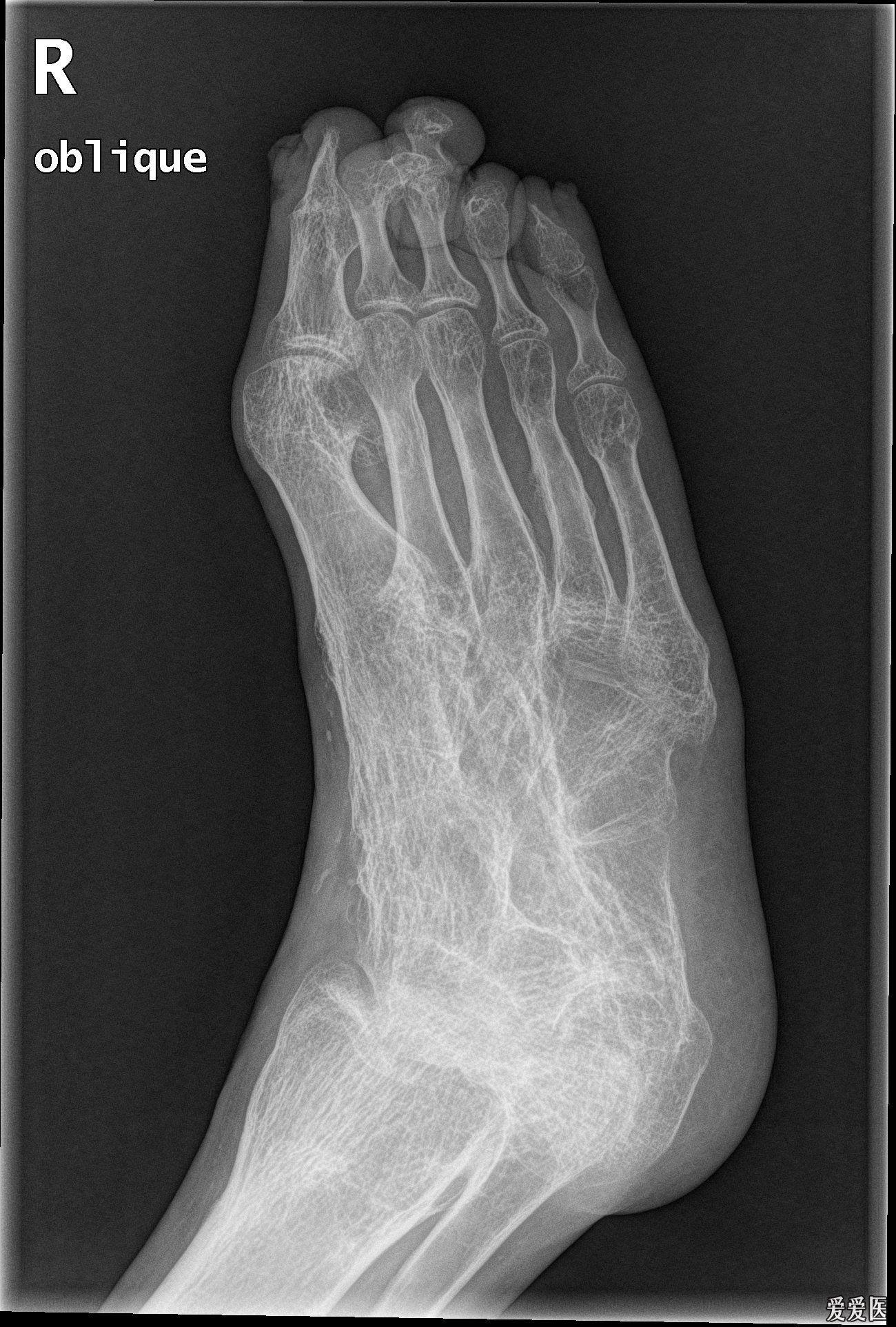 右足病变