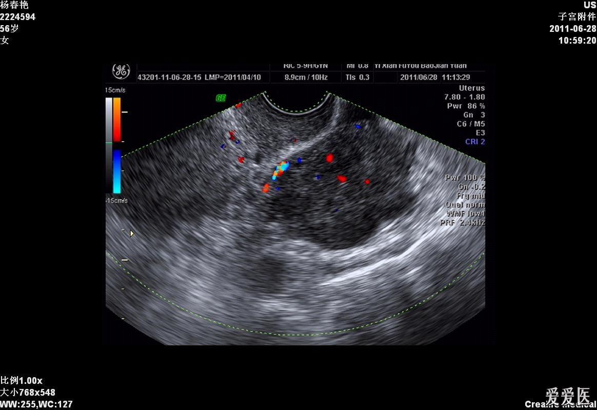 大家看看这个盆腔包块是什么?