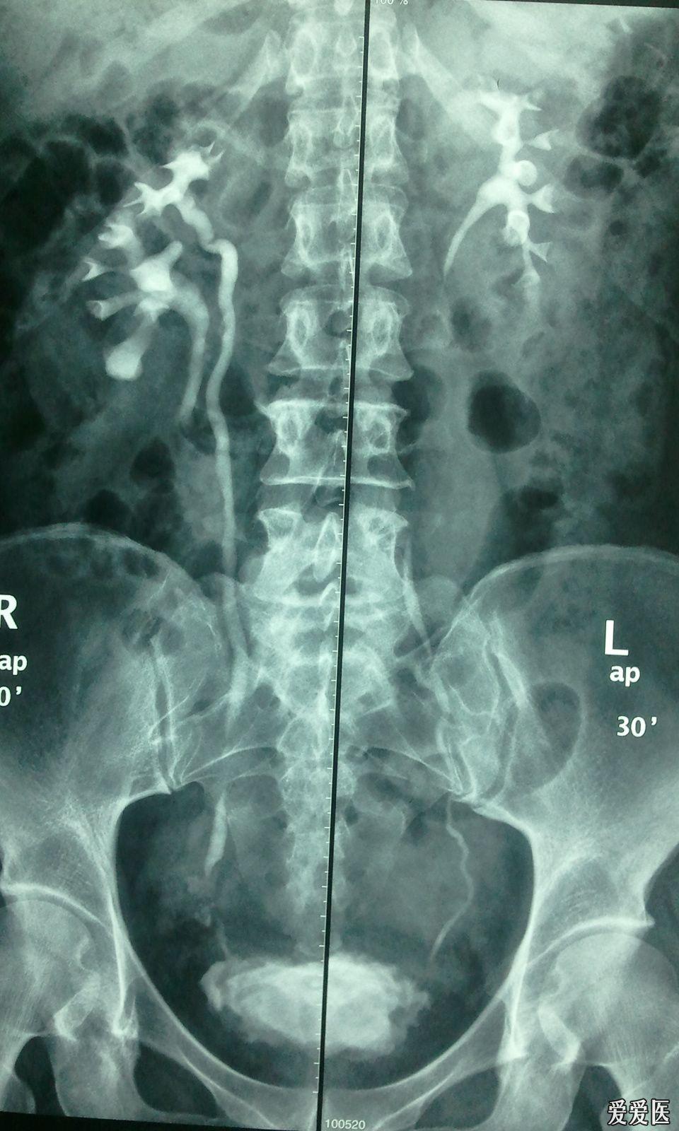 发个双肾盂双输尿管重复畸形的视频