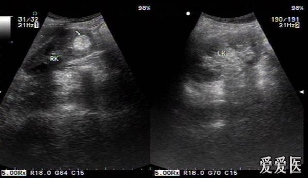 错构瘤超声图片图片