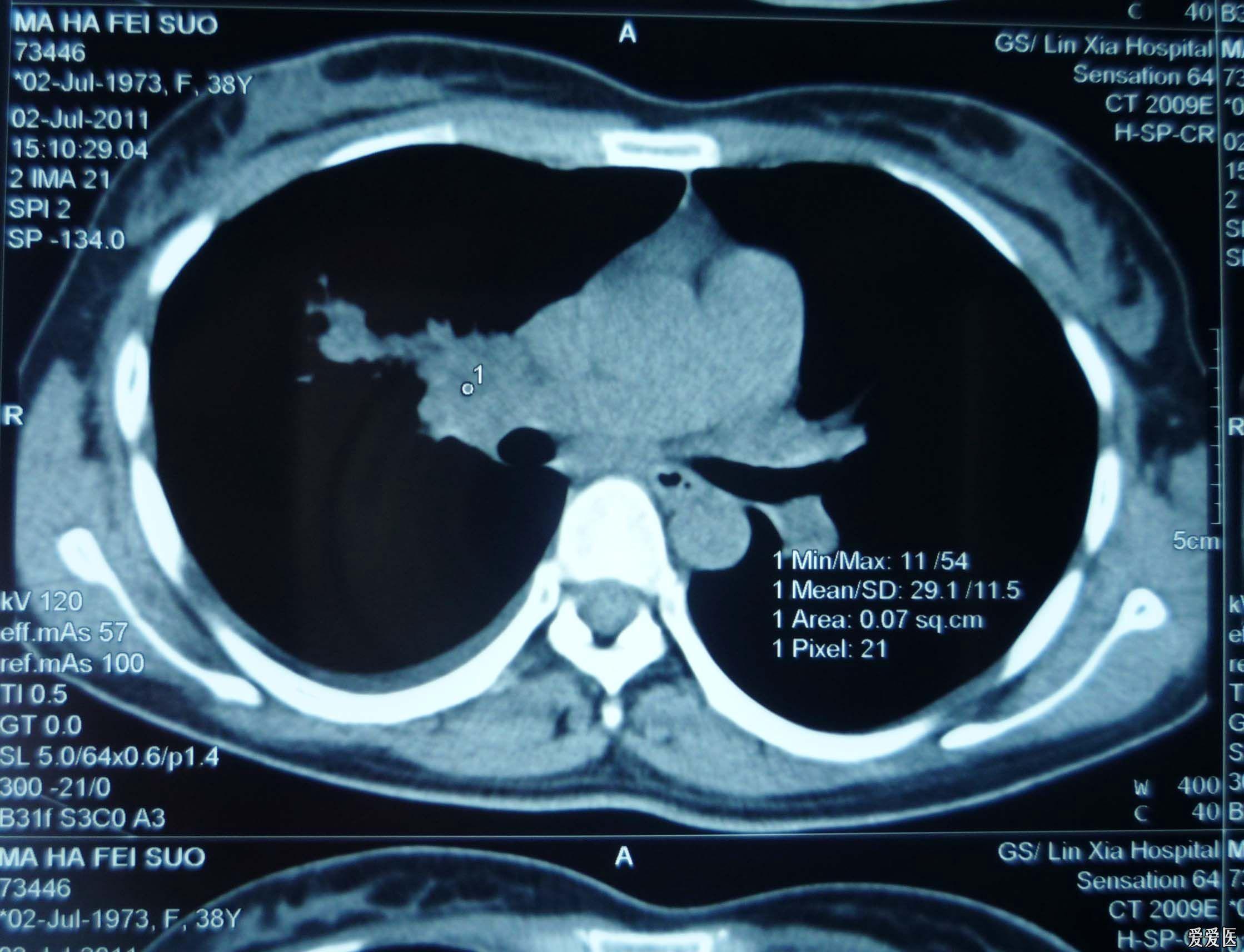 肺癌胸腔积液图片