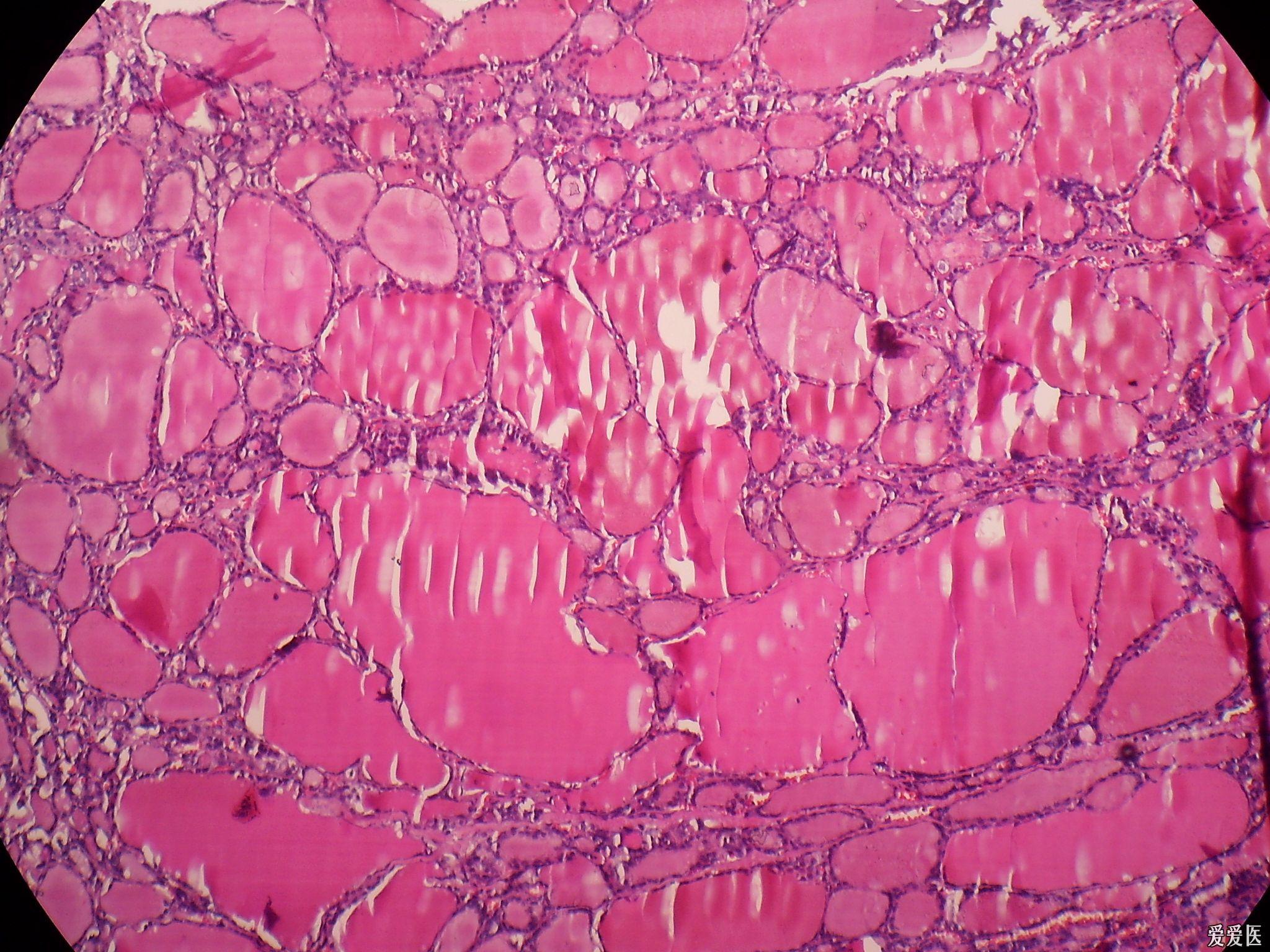 结节性甲状腺肿病理图片
