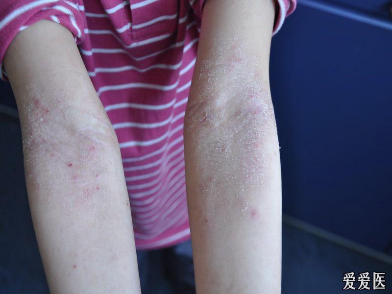 儿童冬季干性湿疹图图片