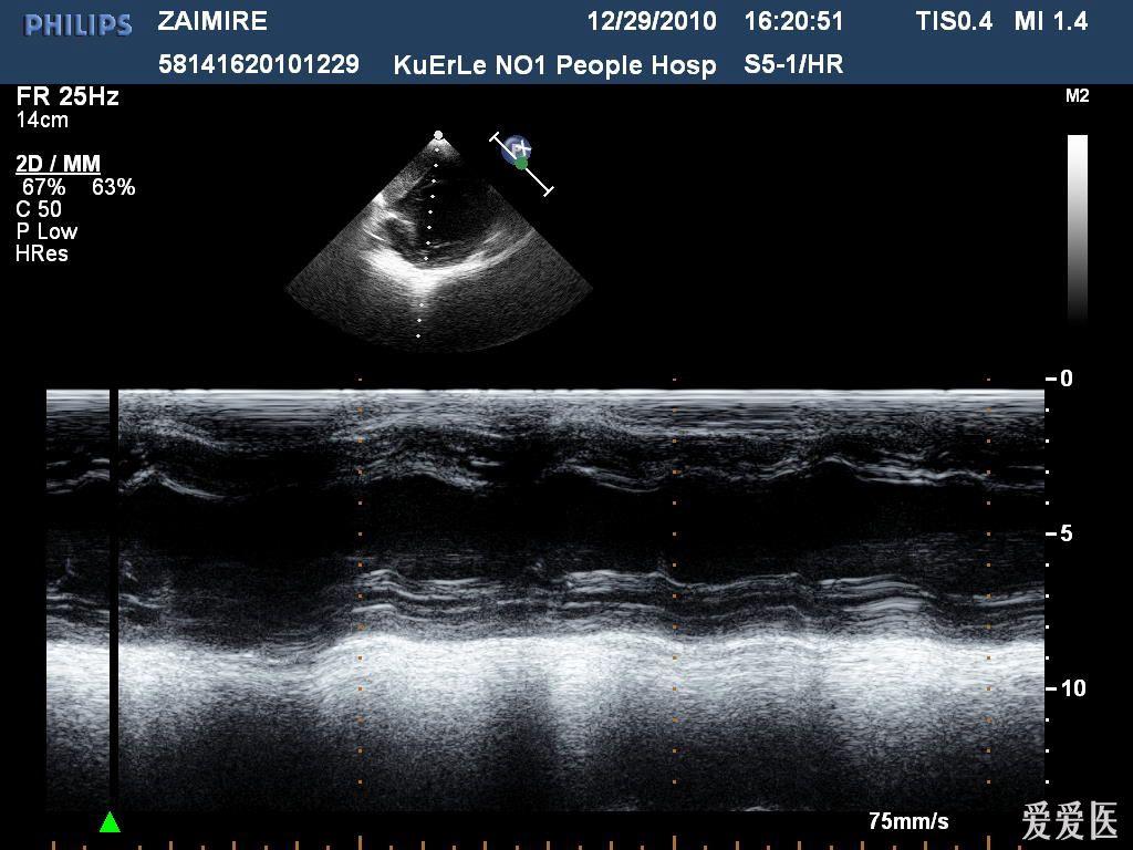 心内膜弹力纤维增生症