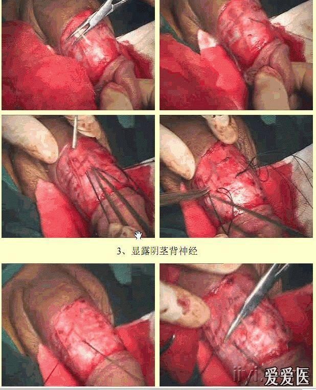 求阴茎背神经阻断术视频