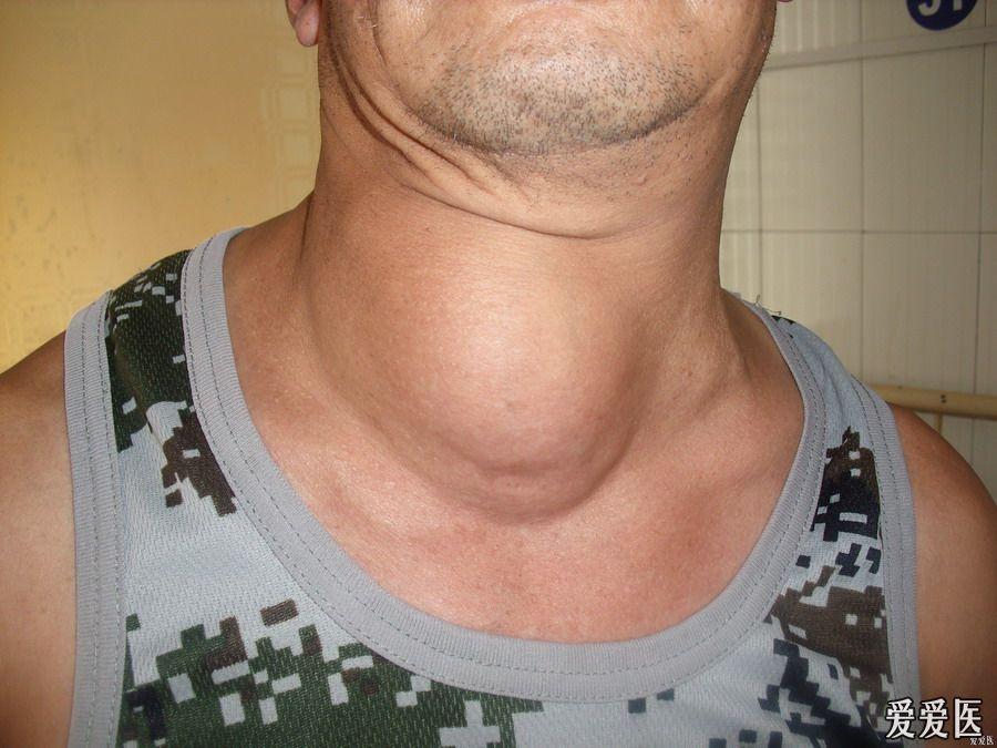 大脖子病初期症状图片图片