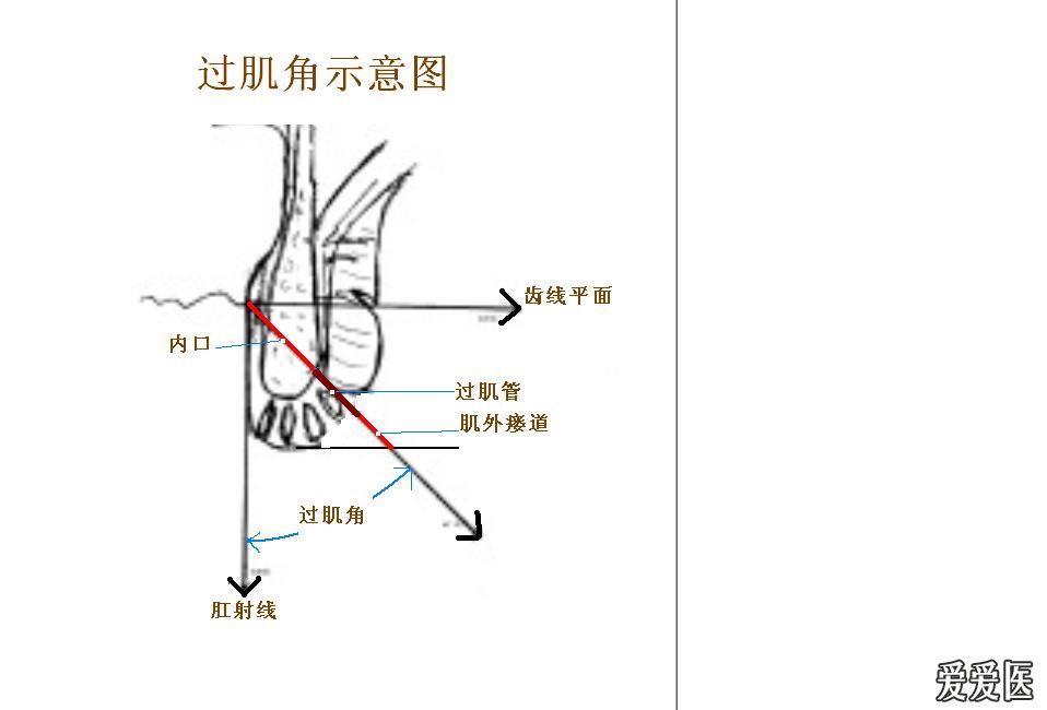 肛瘘低位高位区分图片